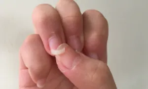 Dấu hiệu cơ thể thiếu vitamin, khoáng chất